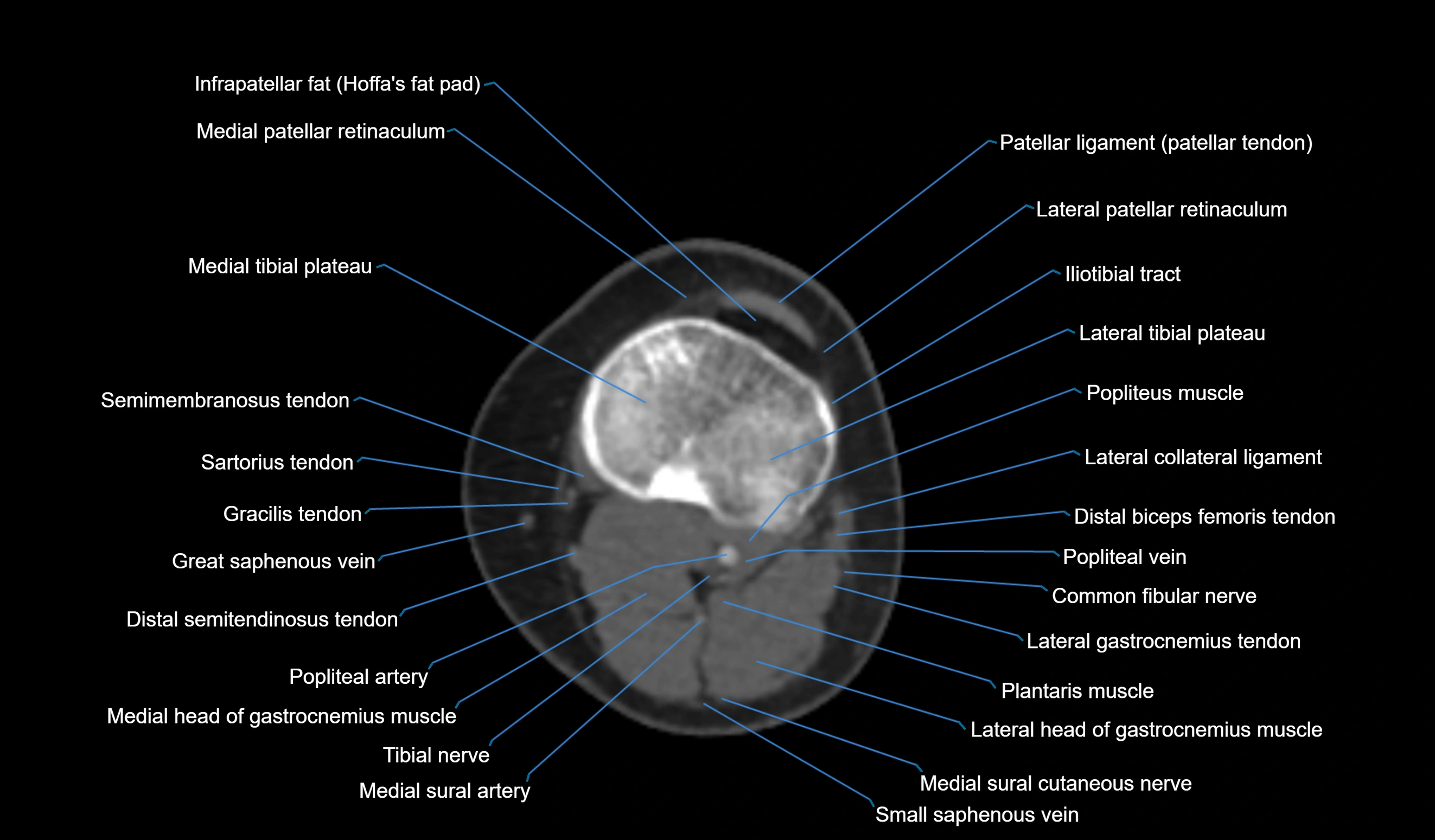 CT knee axial cross sectional anatomy labelled image-00040.webp
